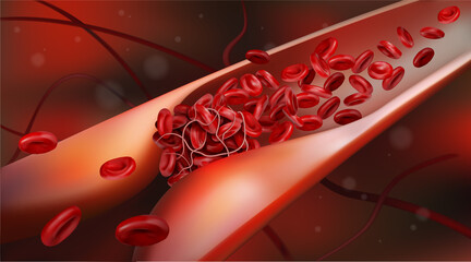 Vein with red blood cell flow and blood clot. 3d vector illustration
