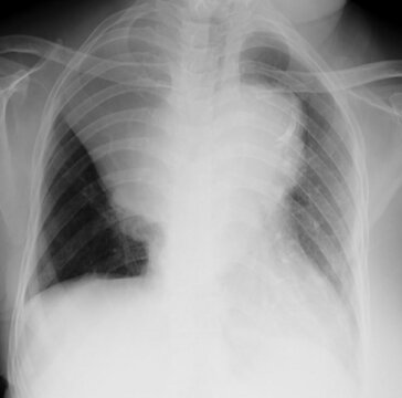 Golden’s S Sign, Reverse S Sign of Golden,  chest x-ray