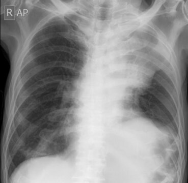 Golden’s S Sign, Reverse S Sign of Golden,  chest x-ray