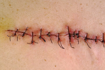 Medical sutures, stitches after surgery, stitched surgical sutures on human body. Medical surgical care. - 508744535