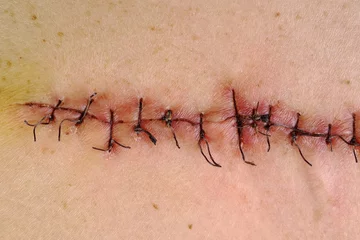 Fotobehang Medical sutures, stitches after surgery, stitched surgical sutures on human body. Medical surgical care. © Dmytro Furman