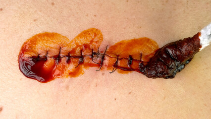 Medical sutures, stitch after surgery, stitched surgical sutures on human body smeared betadine. - 508744537