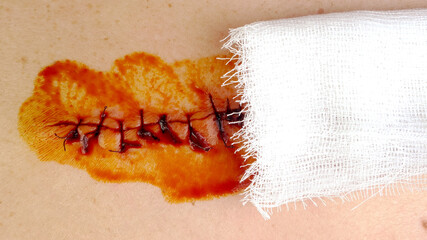 Medical sutures, stitch after surgery, stitched surgical sutures on human body smeared betadine. - 508744544