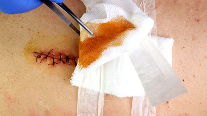 Medical sutures, stitch after surgery, stitched surgical sutures on human body smeared betadine. - 508744545