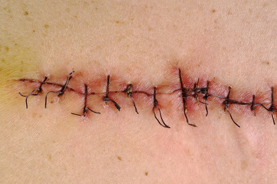 Stitches Injury Images – Browse 4,628 Stock Photos, Vectors, and Video