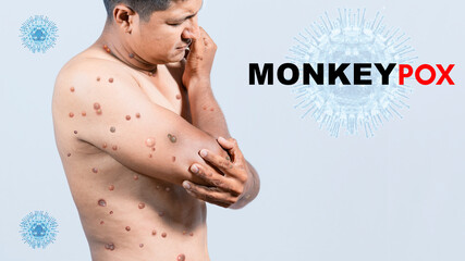 A person with monkeypox on his body, People with monkeypox on isolated background, monkeypox virus...