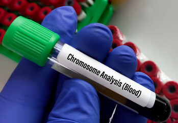 Blood sample for Chromosome analysis blood test to help diagnose genetic diseases, birth defects.