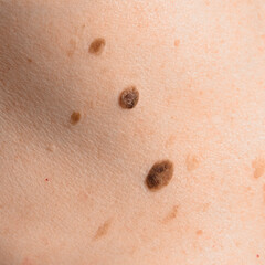 Skin mole on human body. Brown nevi or nevus on back skin. Check moles concept. Closeup. - obrazy, fototapety, plakaty
