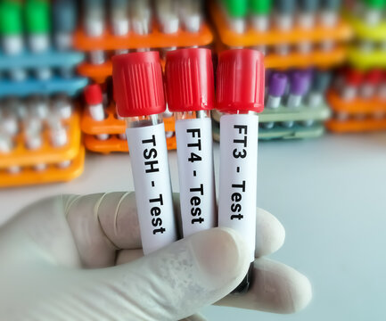 Blood samples for hormonal examination of thyroid gland in laboratory. FT3, FT4, TSH. Diagnosis of hyperthyroidism or hypothyroidism of a patient. Lab background.