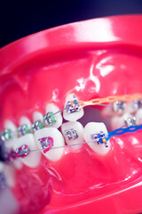 Dental teeth aligners brackets