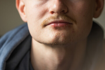 Close up portrait of man's lips infected herpes virus. Painful look. Skin care and daily hygiene concept.