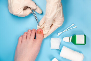 doctor cuts the injured toenail. Hands in rubber gloves touch injured toenail in clinic. Diagnosis, treatment of mycosis of feet. Podiatrist treating ingrown toenail. Inflammation of the toes