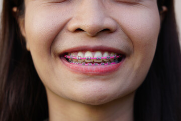 Asian women smile with beautiful braces.