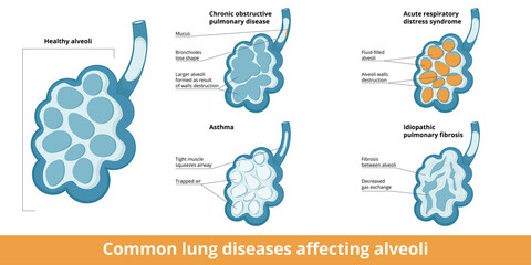 Common alveoli damages. Differences between changes caused by lung diseases: chronic obstructive respiratory disease, asthma, acute respiratory distress syndrome and idiopathic pulmonary fibrosis.