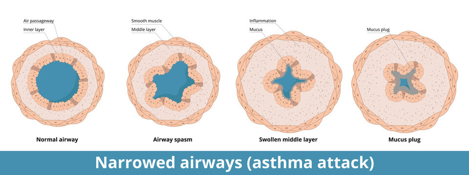 Stages of airways narrowing during asthma attack with possible formation of mucus plug. Smooth muscle layer goes into spasm, middle layer swells, excessive mucus is produced.