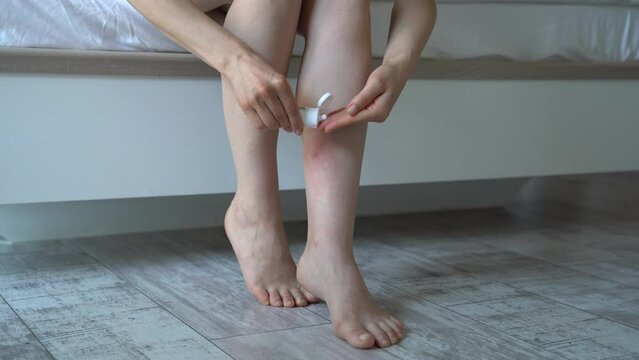 Woman sitting on bed at home, applying cream or balm on swollen skin leg from mosquito or midge bites, suffering from allergic reaction and swelling, itchy sore. Individual intolerance to insect bites