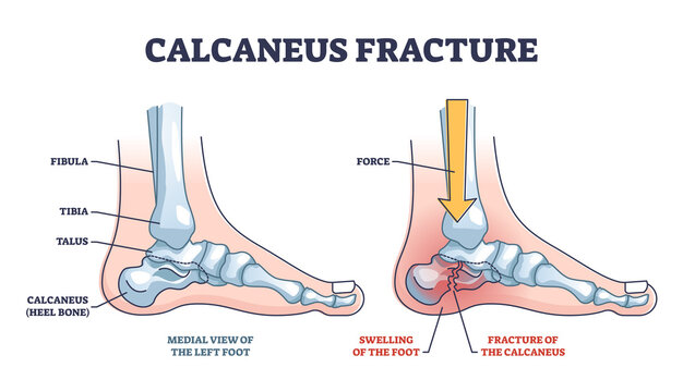 Calcaneus fracture anatomy with broken heel bone structure outline diagram. Labeled educational scheme with physical force direction to broke leg skeletal vector illustration. Medial view of left foot