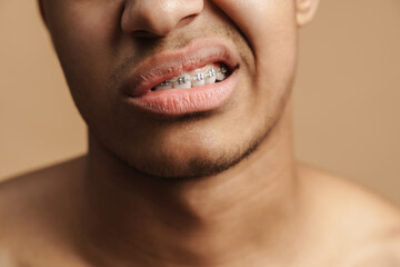 Fototapeta premium Young bristle man showing his dental brace at camera