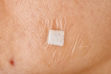 Wound care, Acne treatment, Facial scar wound dressing with sterile pad film.