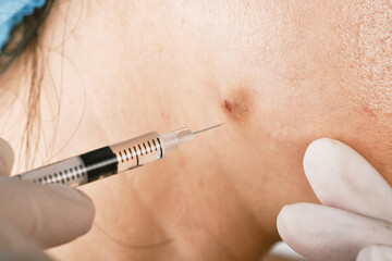 Cystic acne injection treatment, Facial skin problem, Acne disease in adult, Close up woman face...