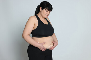 Obese woman with marks on body against light background, space for text. Weight loss surgery