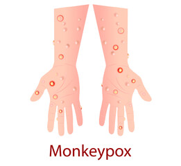 Monkeypox virus that can infect human, Monkey pox. Vector illustration