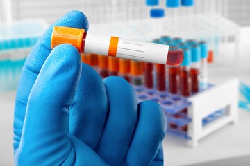 Analysis lab sample of new strain of Coronavirus Omicron.
