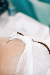 Catheter in vein close-up. International Blood Donation Day. Donor donates blood to save life....