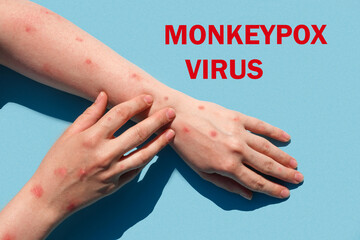 Phrase MONKEYPOX VIRUS on blue background and Patient with Monkey Pox. Monkeypox new disease...