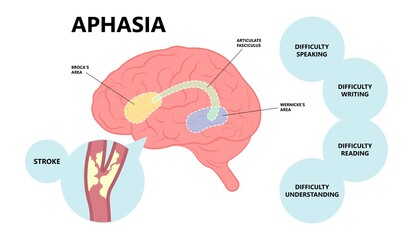 Aphasia brain damage stroke ischemia fatty clots artery leaking attack TIA trauma head tumor treat diagnostic type global Broca’s Wernicke’s Anomic Mixed skill problem sign Nonfluent blockage cell