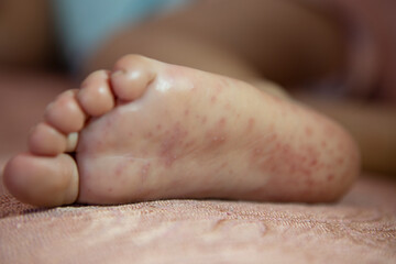 Strong rash on child 's foot