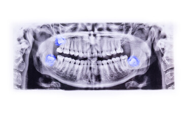 Panoramic dental x-ray, Orthopantomography. radiographs of the teeth, the lower wisdom teeth are...
