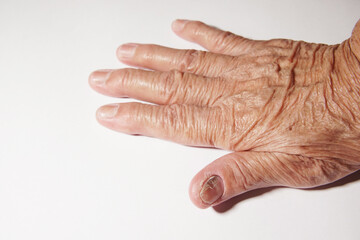 Fingernail of an elderly woman infected with fungal infection.