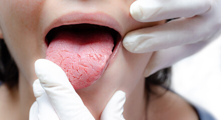 Tongue of a young Caucasian woman with benign migratory glossitis, held by a doctor wearing white gloves. Tongue with candidiasis. Cracks in the tongue. © Catalina