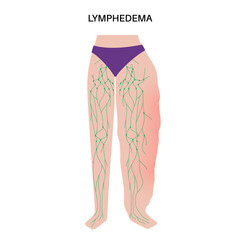 Lymphedema leg swelling