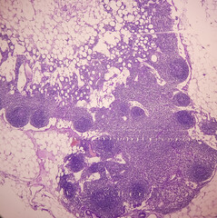Resected lower part of stomach(biopsy): Lymph node show metastatic adenocarcinoma, moderately differentiated. Stomach cancer. 