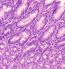 Resected lower part of stomach(biopsy): Lymph node show reactive change, Gastric biopsies,Stomach...