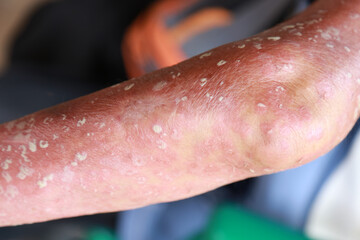 Skin disorder, pepper appearance from scleroderma, autoimmune disease male hand Skin disorder...