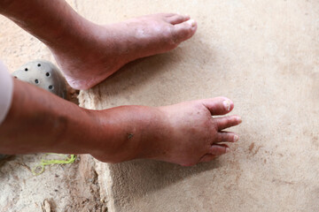 Skin disorder, pepper appearance from scleroderma, autoimmune disease male hand Skin disorder pepper appearance from vitiligo,scleroderma raynaud, medical concept autoimmune disease. Skin disorder,