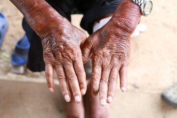 Skin disorder, pepper appearance from scleroderma, autoimmune disease male hand Skin disorder...