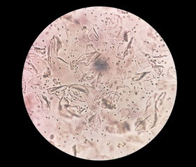 Microscopic urine examination showing Hyaline cast with plenty pus cell and plenty RBC