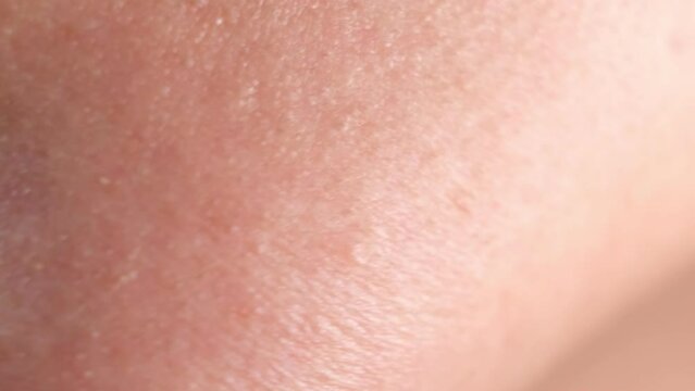 Human skin. Close up. common skin diseases include: Acne, blocked skin follicles that lead to oil, bacteria and dead skin buildup in your pores.