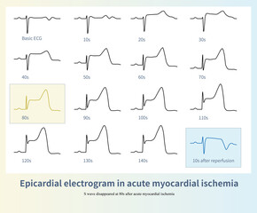 Naklejka premium The epicardial electrogram of acute myocardial ischemia was recorded by ligating the left anterior descending branch of the pig. Note T wave inversion during reperfusion.