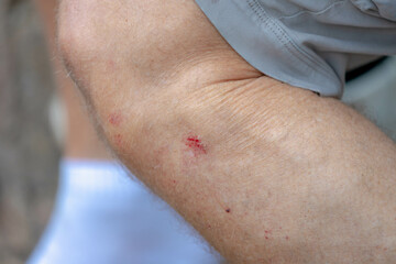 Fototapeta premium Healthcare and medical concept, A man showing a little bit lesion on his leg, Accident wound or abrasion marks on the right side limb, Injuries after working in the garden.