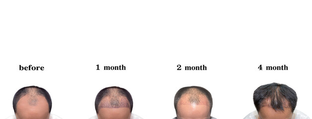 Hair transplantation surgery steps. Patient before and after the procedure. Male hair loss treatment with FUT, FUE method. Alopecia medical design for clinics and diagnostic centers. - obrazy, fototapety, plakaty