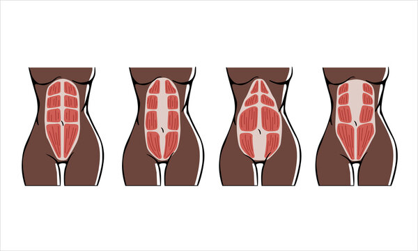 Different types of Diastasis on non-Caucasian skin. Diastasis in a woman after pregnancy and childbirth. Woman anatomy. 
Muscle corset of a woman after childbirth. Vector illustration