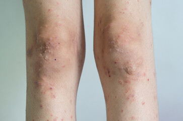 red rash girl Skin disease caused by allergies to drugs, food, chemicals, poor immune system in the lymph.