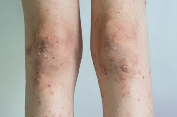 Naklejka premium red rash girl Skin disease caused by allergies to drugs, food, chemicals, poor immune system in the lymph.