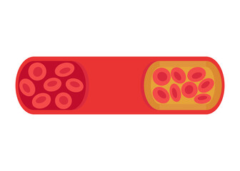 Change of vessel from normal to cholesterol-blocked artery. Blood clot, thrombus, atherosclerotic plaque. Deep vein thrombosis DVT or arterial clot, blood vascular flow. Blocked circulation. Vector