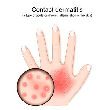 Contact dermatitis. Atopic eczema